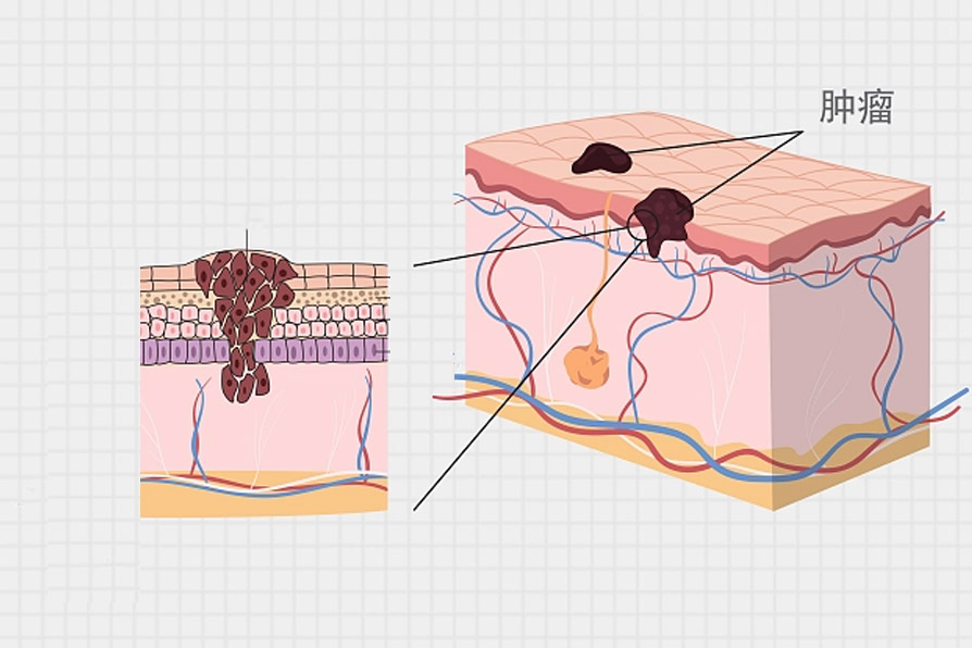 痣发生癌变.jpg