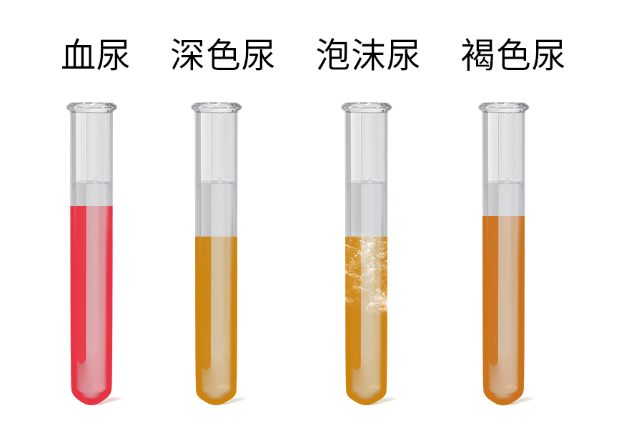 血尿 深色尿  泡沫尿 褐色尿.jpg