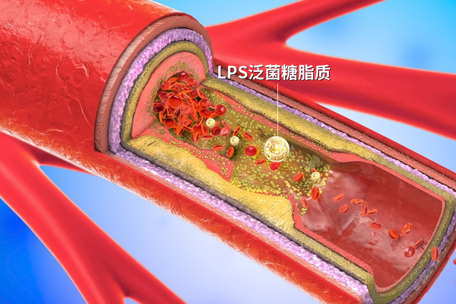 lps清除血管异物.jpg