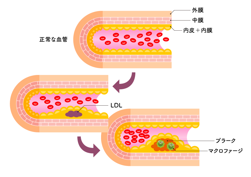 LPS能有效预防动脉粥样硬化！